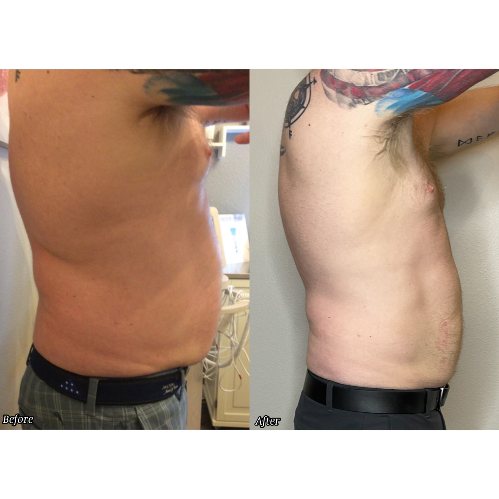 Body Contouring Results before and after