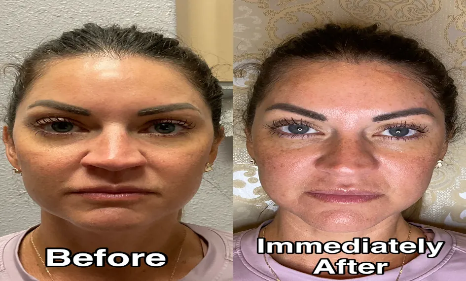 Dermal Fillers (Face) before and after