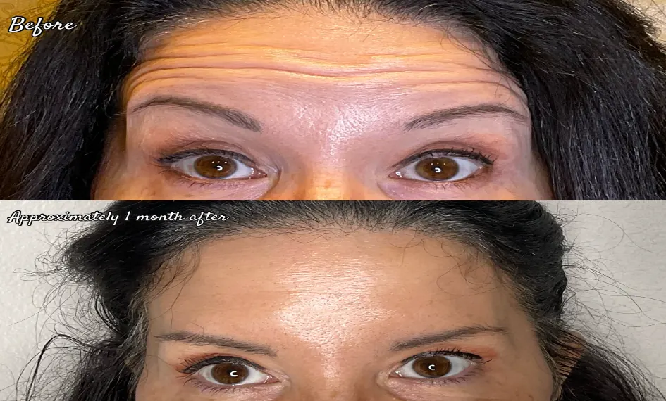 Botox (Forehead Lines) before and after