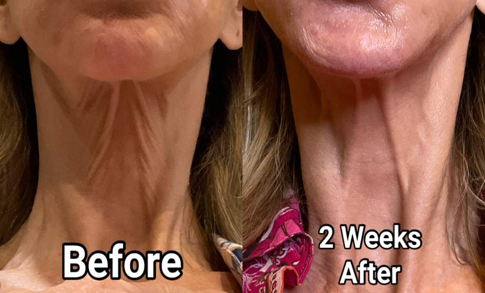 Neck Tightening before and after