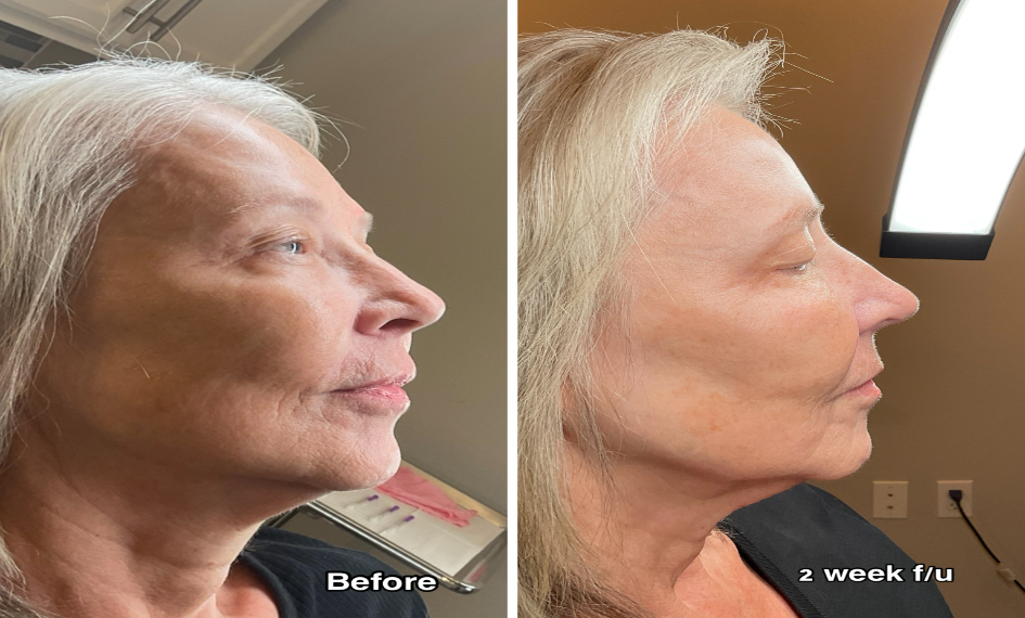 Profile Rejuvenation before and after
