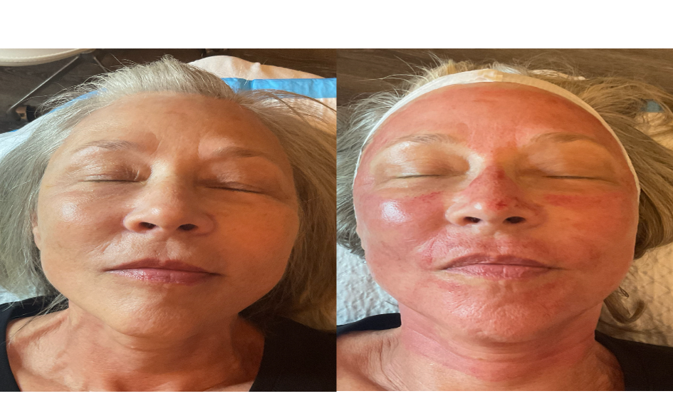 Skin Rejuvenation before and after
